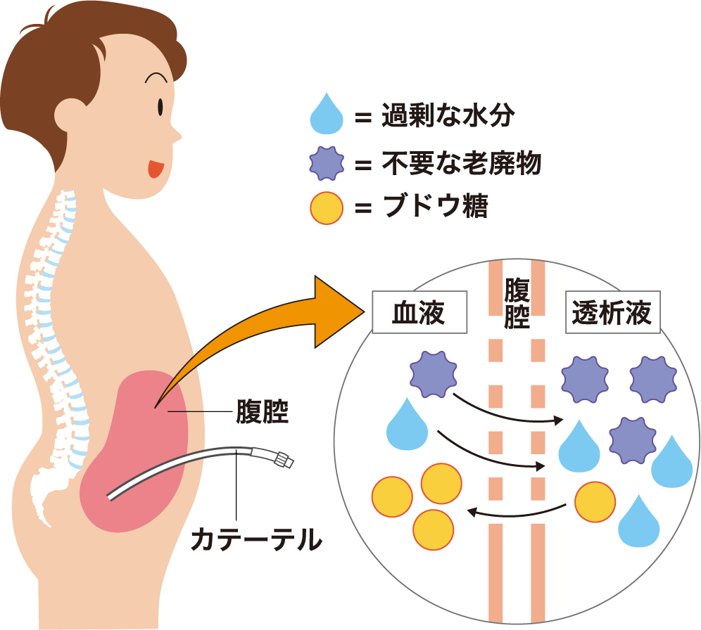 図：腹膜を利用して血液中の余分な水分や老廃物を取り除く