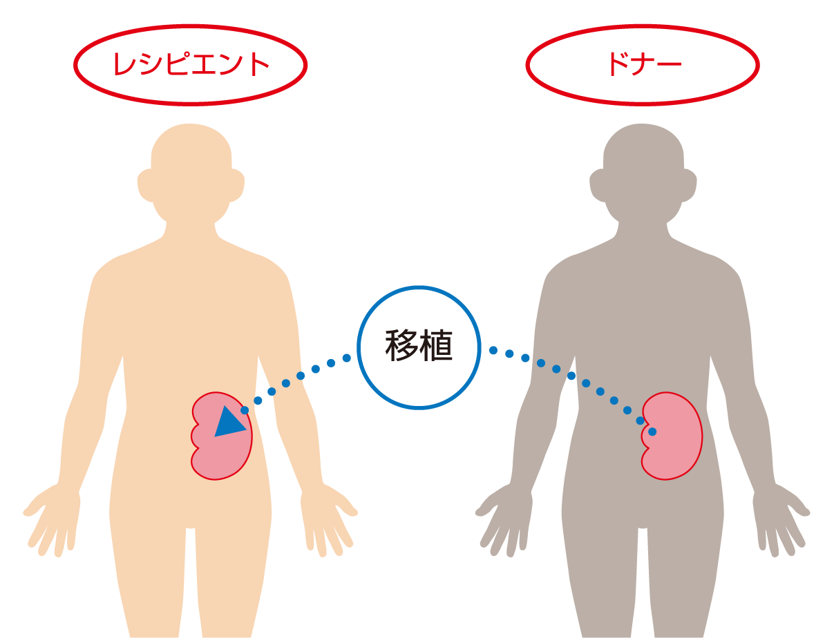 図：ドナーからレシピエントに1つの腎臓を移植