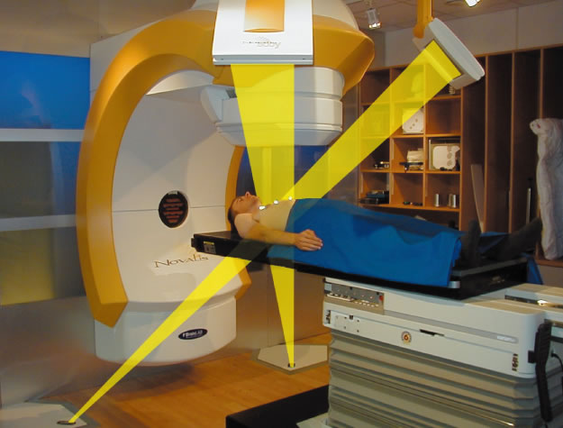 体幹部の定位放射線治療、ノバリスの特徴