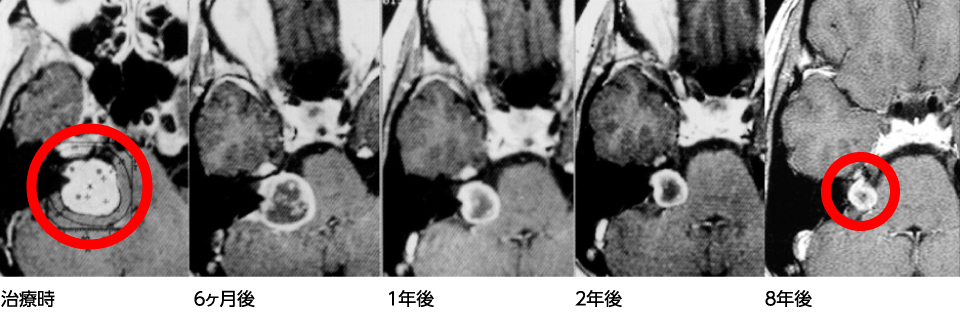 脳腫瘍－治療例　聴神経腫瘍