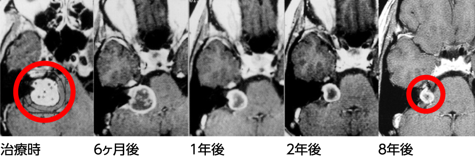 脳腫瘍－治療例　聴神経腫瘍