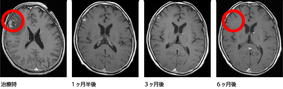脳腫瘍－治療例　転移性脳腫瘍