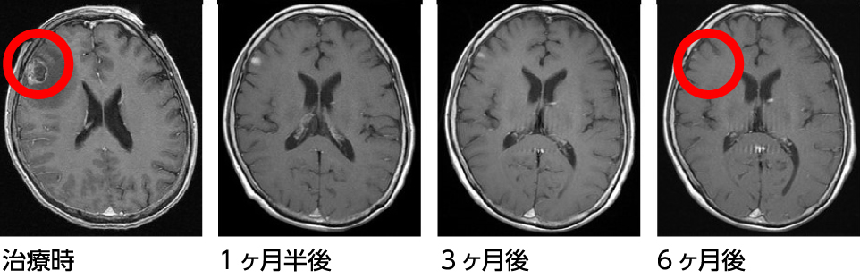 脳腫瘍－治療例　転移性脳腫瘍