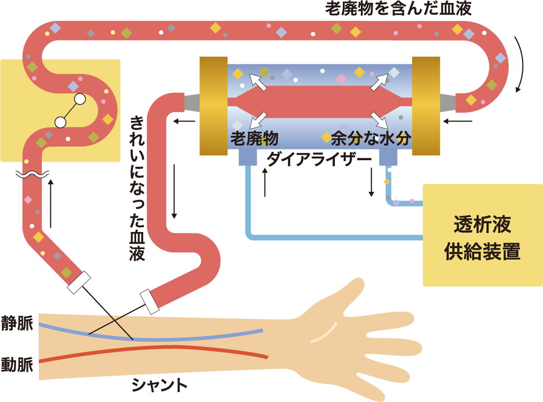 図：腕の静脈に針を刺し、ポンプを使って血液を体外に送り、ダイアライザーを通して老廃物や余分な水分を透析液に移し、きれいになった血液を体内に戻す。