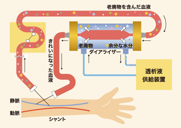 イラストで学ぼう 腎臓のおはなし 偕行会グループの透析医療