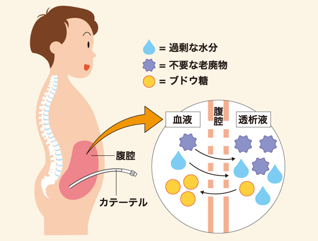 イラストで学ぼう 腎臓のおはなし 偕行会グループの透析医療